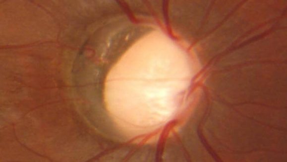 Glaucoma Figure 1
