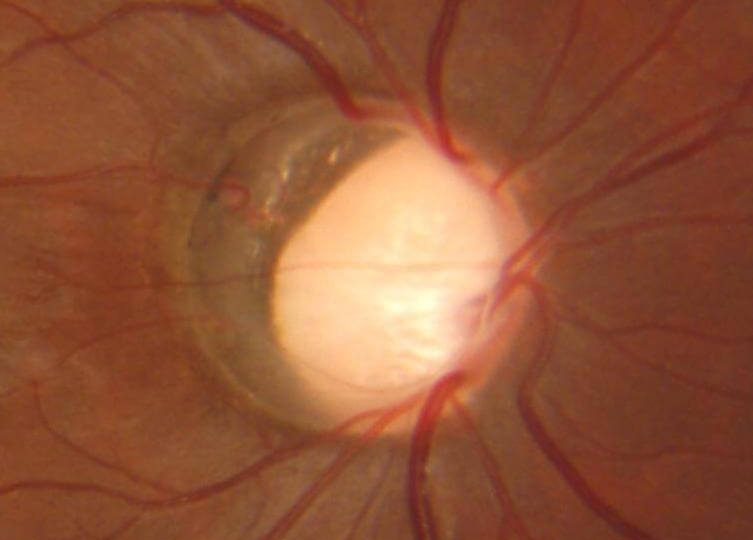 Glaucoma Figure 1
