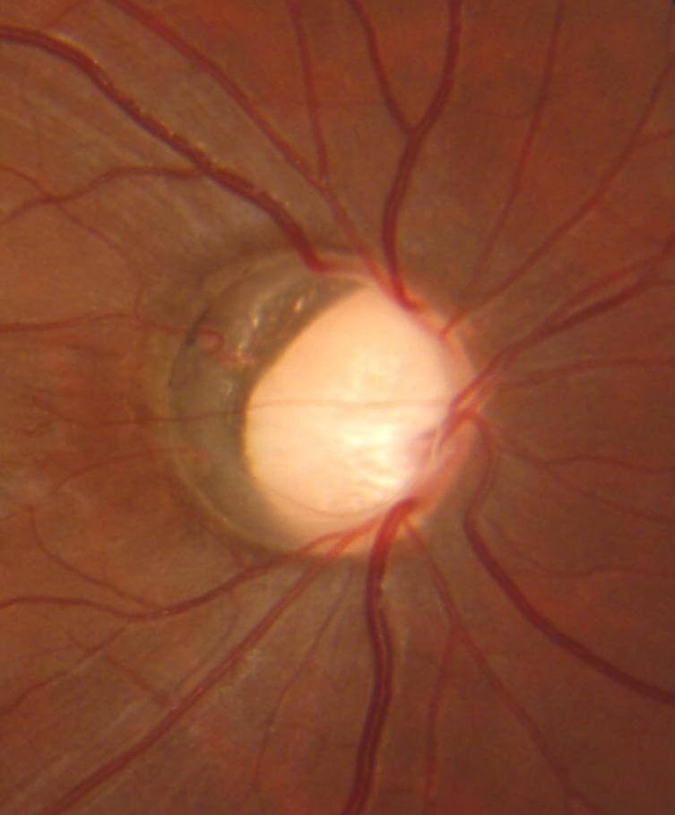 Glaucoma Figure 1