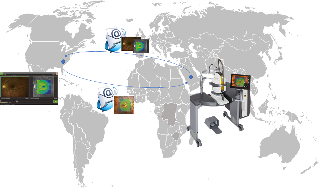 Photocoagulation Kozak Worldmap diagram 1