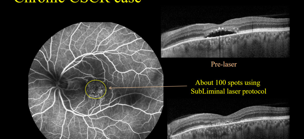 Chronic CSCR_courtesy