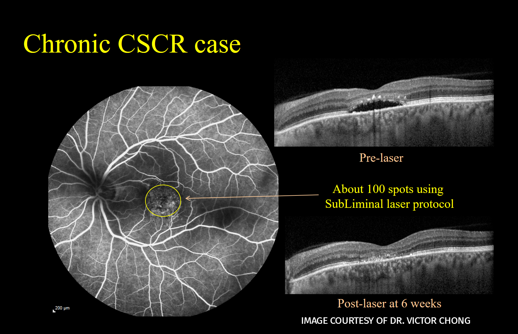 Chronic CSCR_courtesy