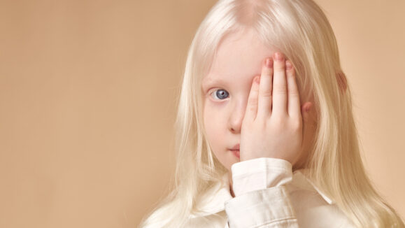 Albino.,Cute,Caucasian,Little,Girl,With,Albinism,Syndrome,,She,Closed