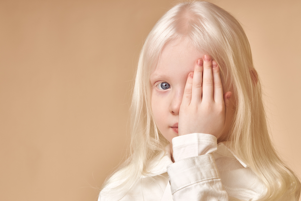Albino.,Cute,Caucasian,Little,Girl,With,Albinism,Syndrome,,She,Closed