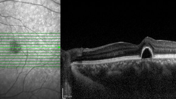 Optical,Coherence,Tomography,(oct),Image,Of,Eye,In,The,Patient