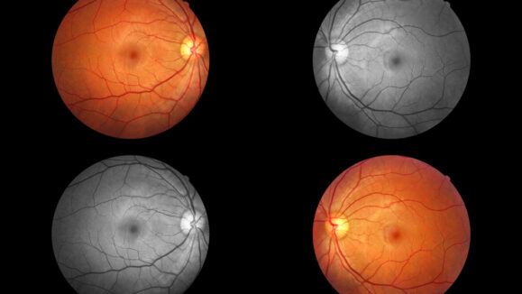 Human,Eye,Anatomy,Taking,Images,With,Mydriatic,Retinal,Cameras