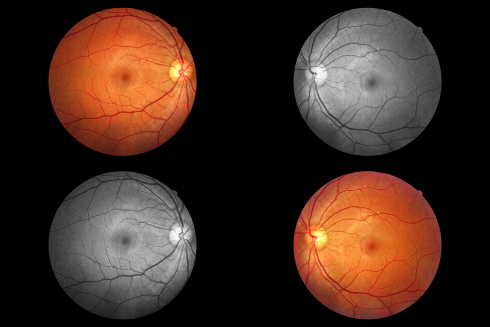 Human,Eye,Anatomy,Taking,Images,With,Mydriatic,Retinal,Cameras